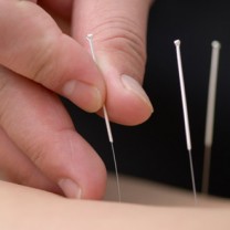 Akupunkturnålar i hud