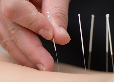 Akupunkturnålar i hud