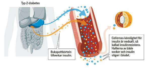 Animerad bild: Detta händer i kroppen vid typ 2-diabetes