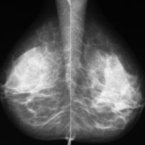 bröstvävnad röntgen