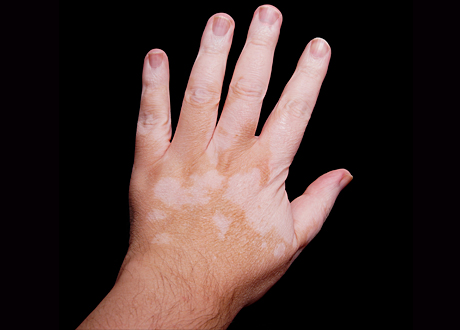 Hur ska jag behandla min vitiligo? Experten tipsar