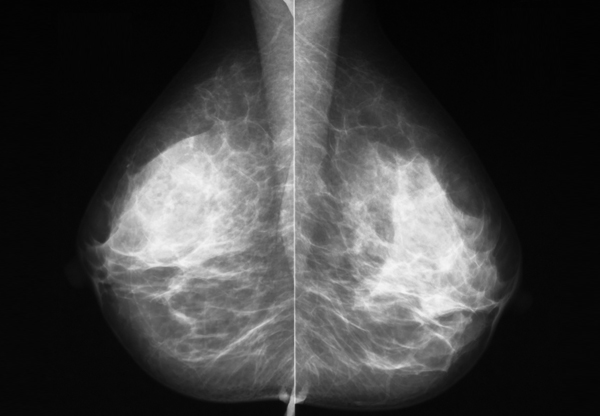 Omtvistad nytta med mammografi
