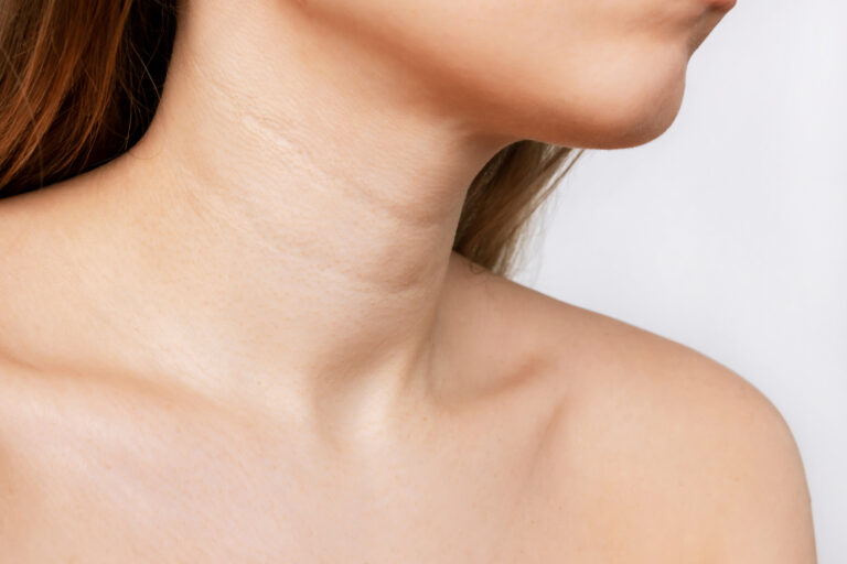 Närbild på kvinna med synliga linjer på halsen
